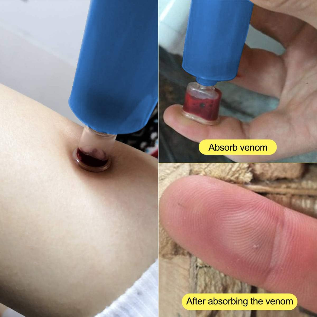 Snake Bite Kit, Bee Sting Kit, Emergency First Aid Supplies, Venom Extractor Suc