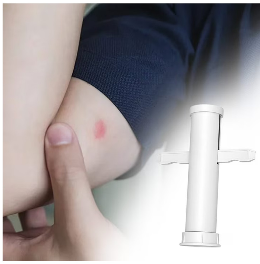 2 PK Bug Bite Relief Insect Poison Remover Suction Tool For Insect Bite Sting